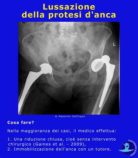 Trattamento di una lussazione dell’anca 